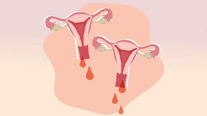 Tình trạng xuất huyết âm đạo cần cấp cứu
